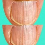 Having striped nails might mean that your body is… 😲