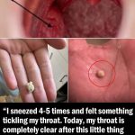 Tonsil Stones: What Are These Strange, Pimple-Like Growths in Your Throat?