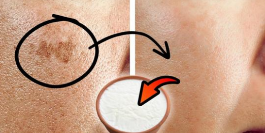 I Erased My Age Spots With a Cheap Kitchen Ingredient — Baking Soda Paste