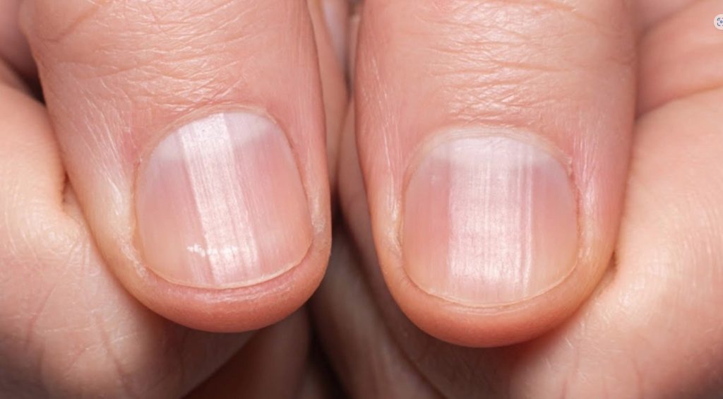 Did You Know That Having Striped Nails Could Mean That Your Body Is…..