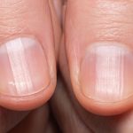 Did You Know That Having Striped Nails Could Mean That Your Body Is…..