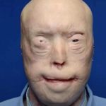 Patrick Hardison Received A New Face After Third-degree Burns, This Is Him Today