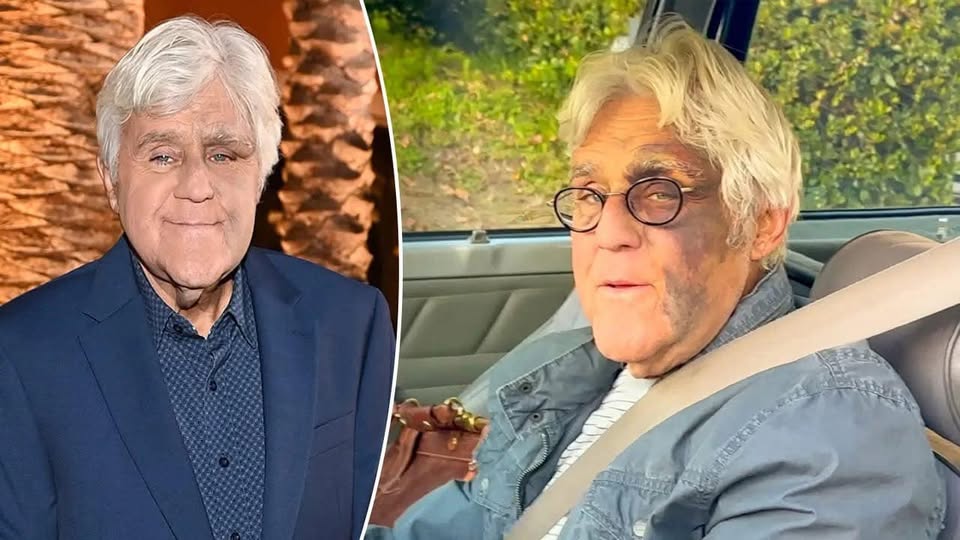 Jay Leno, 74, suffers nasty injuries after falling down hill