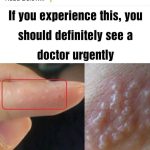 If you see these painful red bumps, you may have dyshidrotic eczema