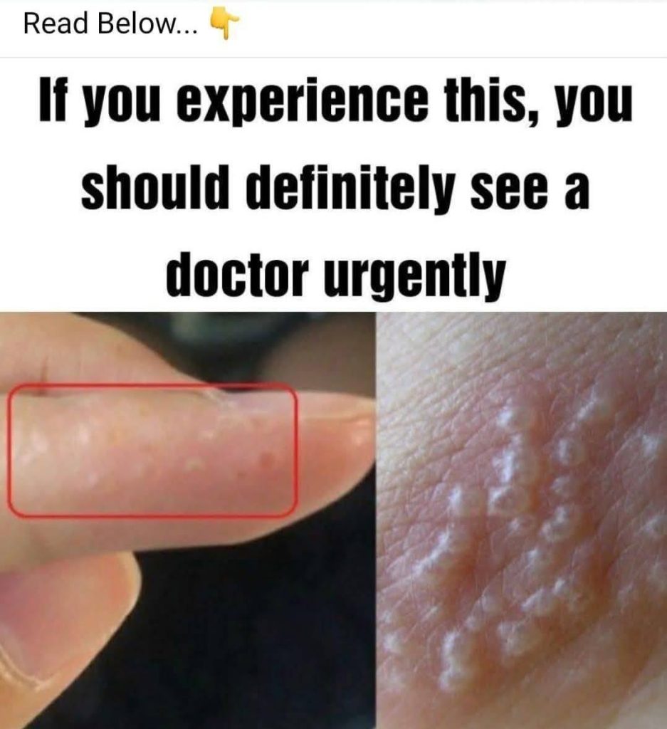 If you see these painful red bumps, you may have dyshidrotic eczema