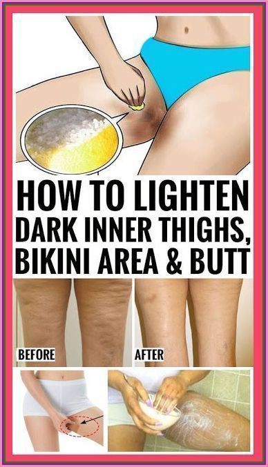 How To Lighten Dark Inner Thighs Naturally