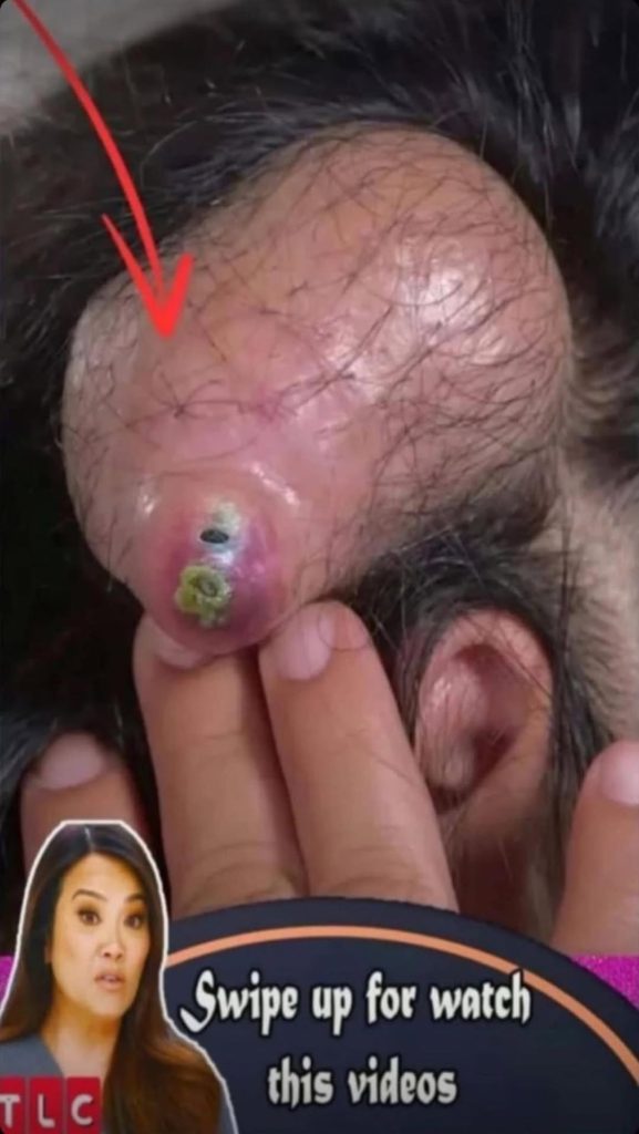 Tracking the Healing Journey of a Giant Bottomless Back Abscess: A Multi-Visit Follow-Up”